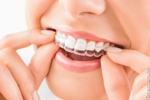 Kinek ajánljuk a láthatatlan fogszabályozást?