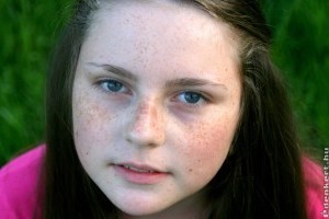 Hiperpigmentáció nem csak környezeti hatások miatt alakulhat ki