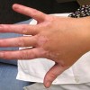 Mit tehetünk a fehér foltok (vitiligo) ellen?
