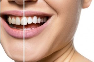 Hogyan legyenek szép fehérek a fogaid fogkárosodás nélkül?