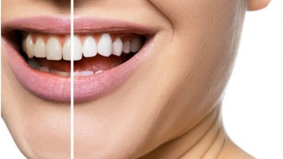 Hogyan legyenek szép fehérek a fogaid fogkárosodás nélkül?